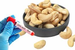 Lượng hạt điều nên ăn để ngăn axit uric cao