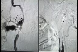 Bệnh nhân ung thư vòm hầu xuất huyết ồ ạt được cứu kịp thời
