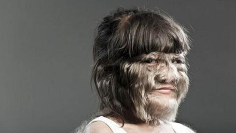 "Cô bé người sói" mắc chứng bệnh lạ cả thế giới chỉ có 50 người từng bị giờ ra sao ở tuổi trưởng thành?