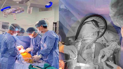 Người bệnh suy tim giai đoạn cuối có thêm cơ hội sống nhờ CorHeart 6