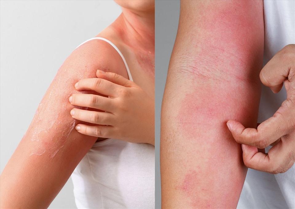 Hướng dẫn làm kem trị mẩn đỏ, ngứa ngáy tại nhà