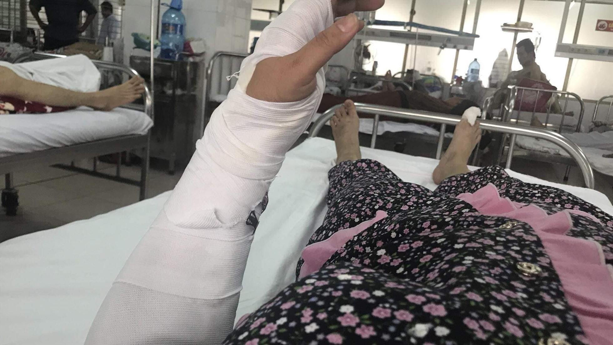 Chị P. bị gãy kín xương trụ tay trái, đa chấn thương. Ảnh: B.P