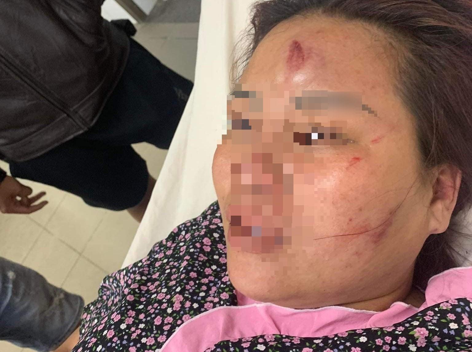Chị P. bị gãy kín xương trụ tay trái, đa chấn thương. Ảnh: B.P