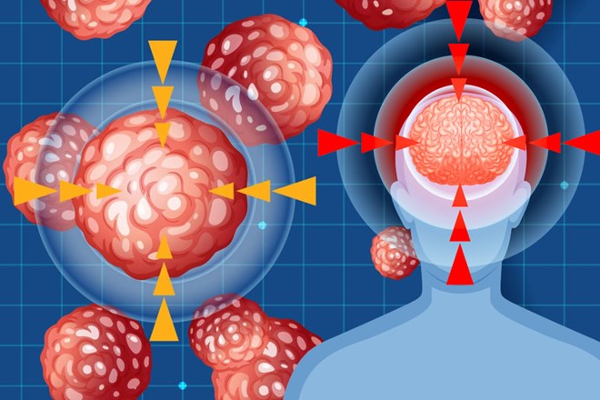 Nguyên nhân gây ra cục máu đông trong não