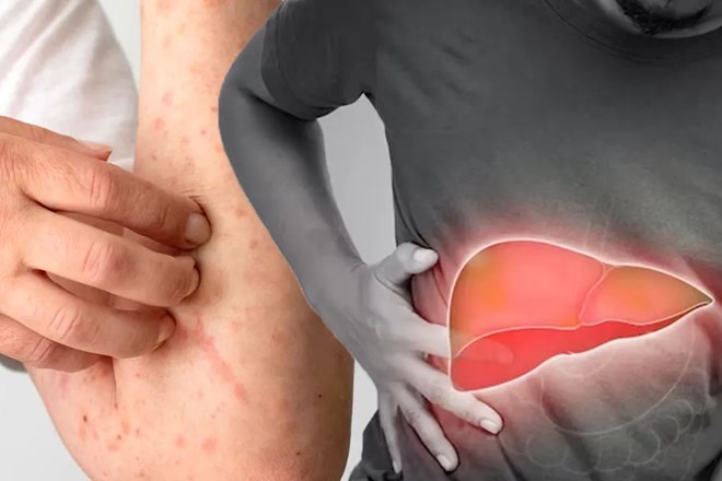 Biểu hiện trên da âm thầm cảnh báo gan đang gặp vấn đề
