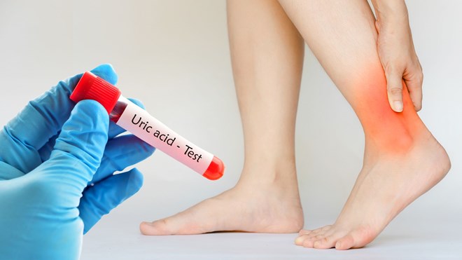 5 dấu hiệu thay đổi cảnh báo axit uric cao và gout
