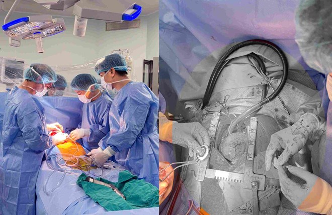 Người bệnh suy tim giai đoạn cuối có thêm cơ hội sống nhờ CorHeart 6